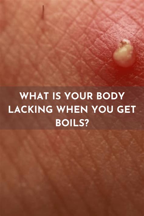 how do you get boils.
